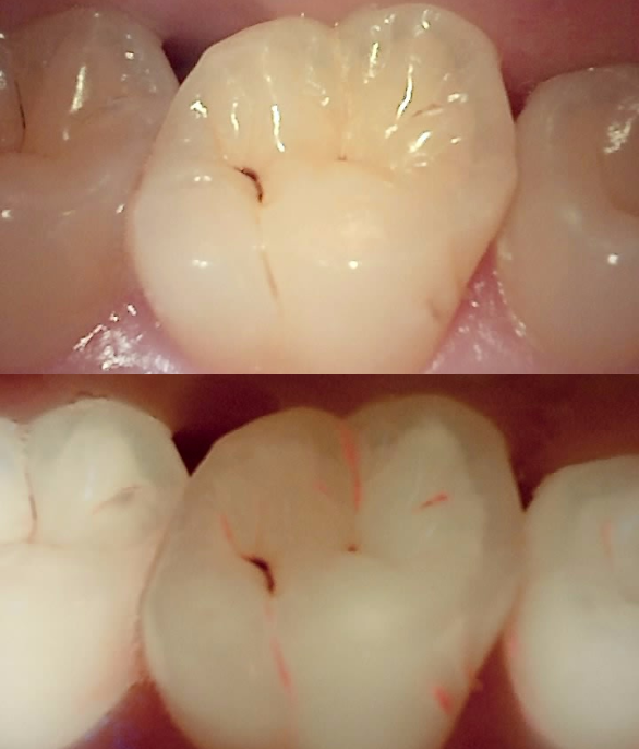 수술 전